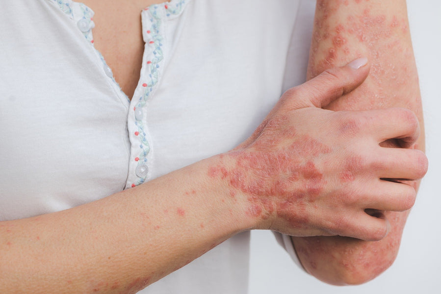 Psoriasis - Prescribed Treatments, Risks, and Possible Alternatives